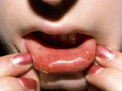 Cẩn trọng tránh bị viêm loét miệng, khô miệng do thuốc